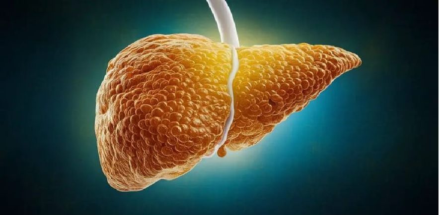 Fatty Liver Future Risks